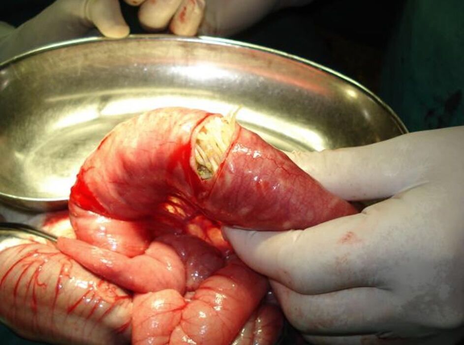Cacing gelang di usus manusia